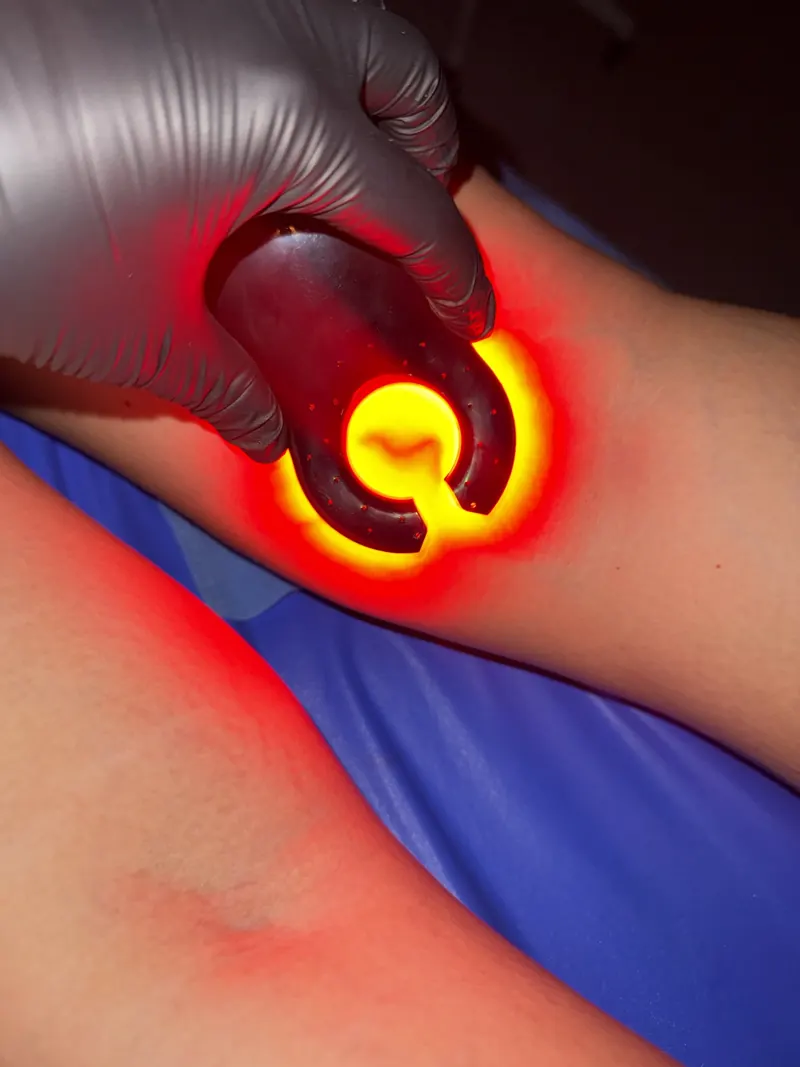 Transiluminación venosa para ubicar las arañitas vasculares antes de la escleroterapia en Bucaramanga